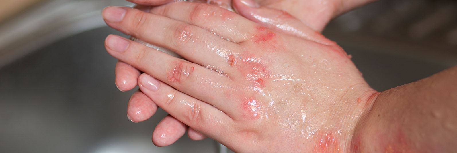 eczema treatments moksha dermatology cincinnnati monroe ohio