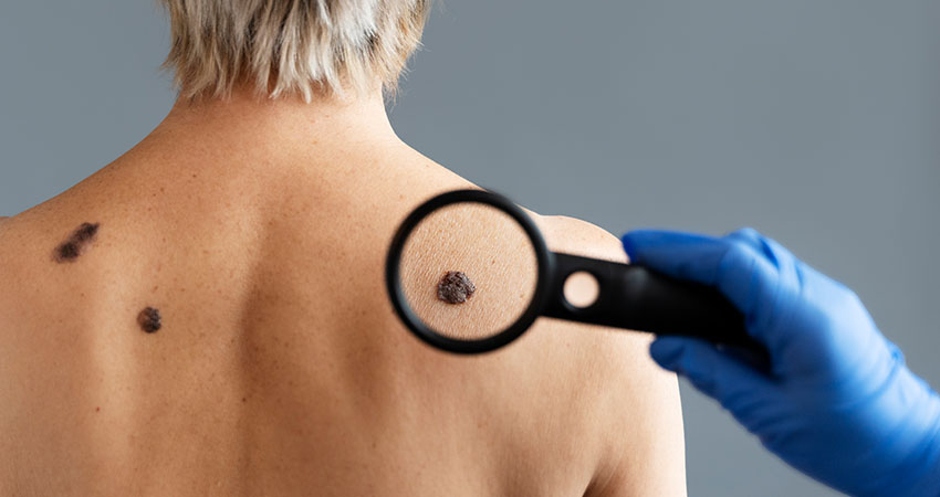 Skin Cancer Screening in Cincinnati Ohio at Moksha Dermatology